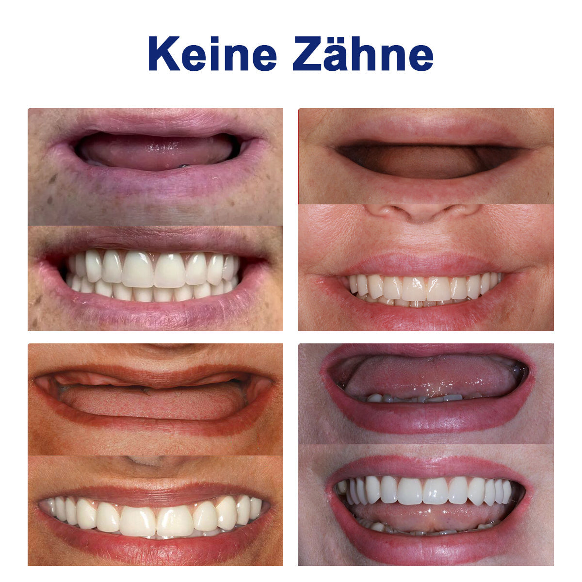 Bikenda™ Silikon-Zahnprothesen-Messset 🧨🧨 (👩‍🔬CED-konform, genehmigt von professionellen Zahnärzten)