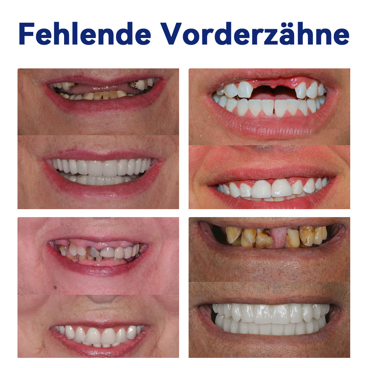 Bikenda™ Silikon-Zahnprothesen-Messset 🧨🧨 (👩‍🔬CED-konform, genehmigt von professionellen Zahnärzten)